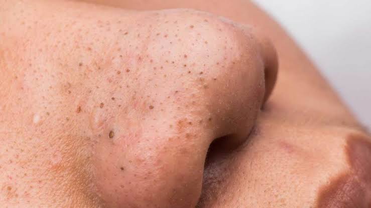 Beauty Tips: Safe And Effective Ways To Remove Deep Blackheads