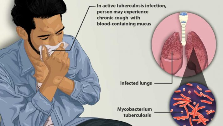  What You Should Know About Tuberculosis And Prevention